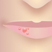 Herpes Bläschen an der Lippe