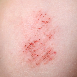 Was tun bei Schürfwunden? | ilon.de