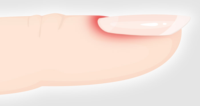 Fleisch finger wildes nagelbettentzündung Behandlung der