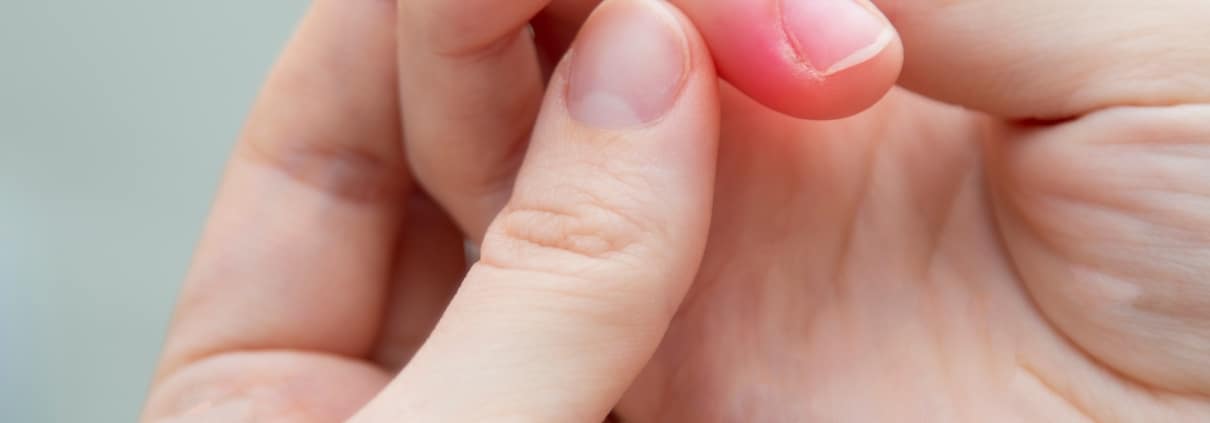 Nahaufnahme von Händen mit einer Entzündung am Nagel