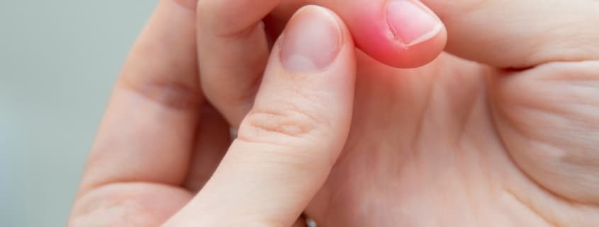 Nahaufnahme von Händen mit einer Entzündung am Nagel