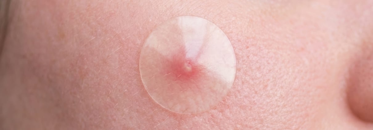 Nahaufnahme von einem Pickel mit einem transparenten Pickelpatch