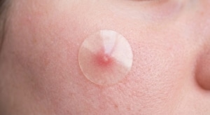 Nahaufnahme von einem Pickel mit einem transparenten Pickelpatch