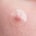 Nahaufnahme von einem Pickel mit einem transparenten Pickelpatch